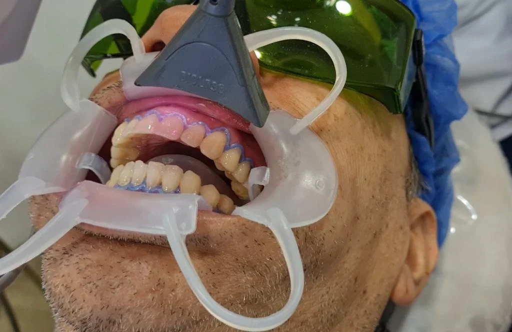 Estética Dental en MDental Láser, El Poblado, Medellín