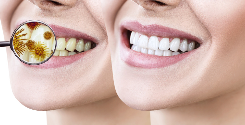 5 causas que provocan el mal aliento - Clinica Dental Urumea