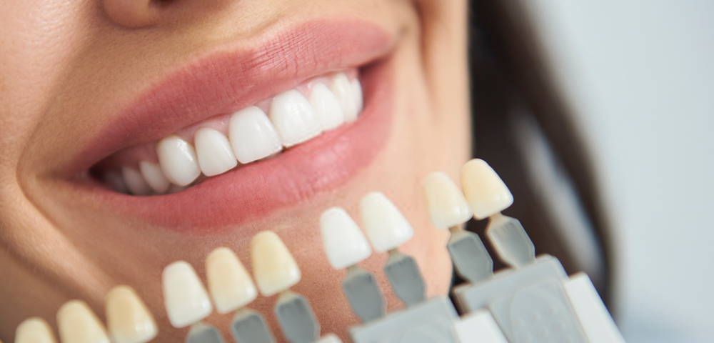 tips para blanqueamiento dental