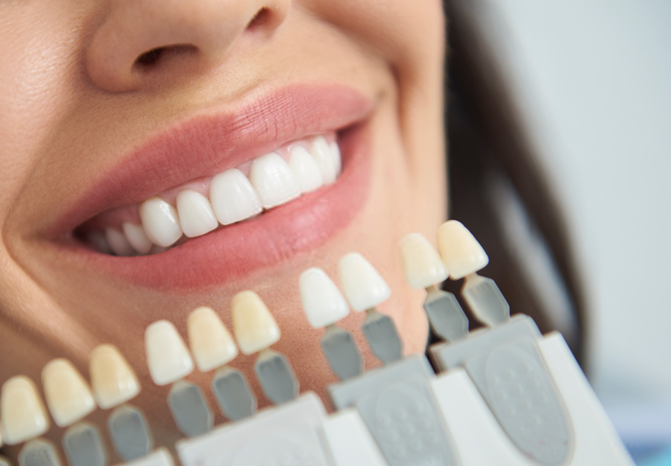 tips para blanqueamiento dental