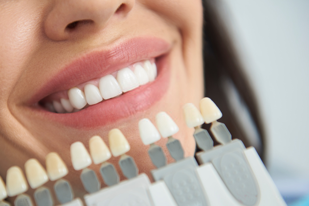 tips para blanqueamiento dental